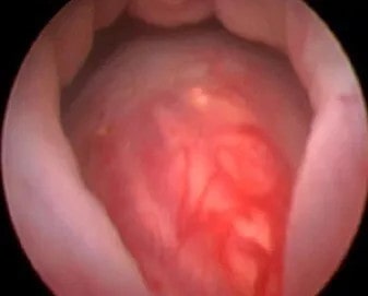 Cystoscopic appearance, Enlarged Prostate, BPH, large median lobe