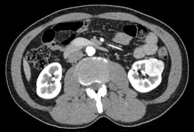 small renal mass, kidney tumour, kidney cancer, T1 tumour, CT scan, computed tomography