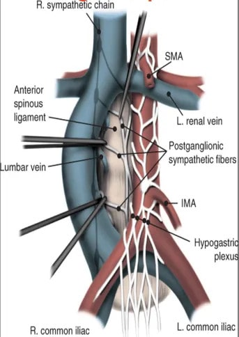 RPLND Anatomy, retroperitoneal lymph node dissection
