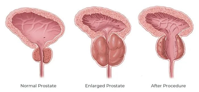 BPH, enlarged prostate, TURP, Transurethral Resection of the Prostate