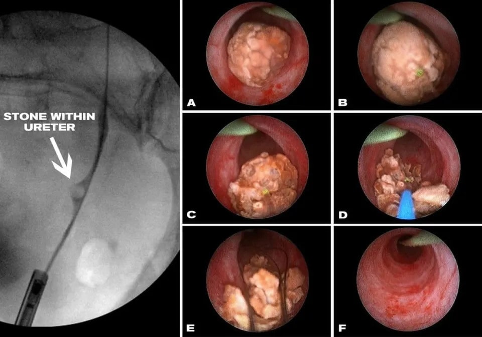 Ureteroscopy - kidney stone and urinary stone treatment sydney