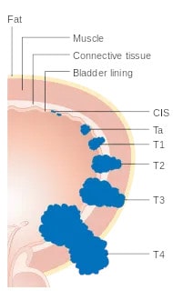 T staging, bladder cancer