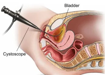 Flexible Cystoscope in Female