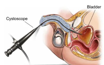 Flexible Cystoscope in Male
