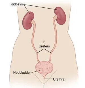 neobladder, urinary diversion