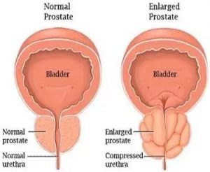 normal prostate, enlarged prostate, BPH