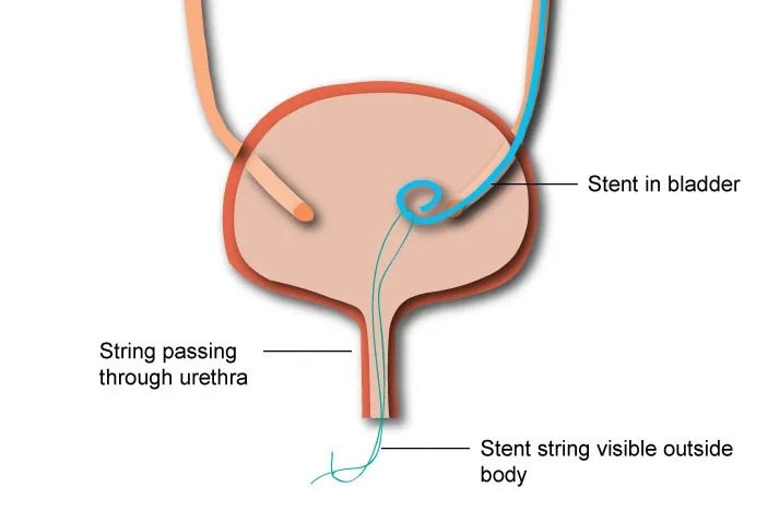 Stent on a string, tethered stent, kidney stone, laser stone surgery, laser lithotripsy