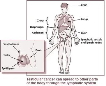 Testicular cancer spreading