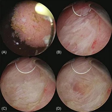 Cystoscopic appearance, TURBT, Transurethral resection of bladder tumour, bladder tumour, bladder cancer, urothelial cancer of bladder