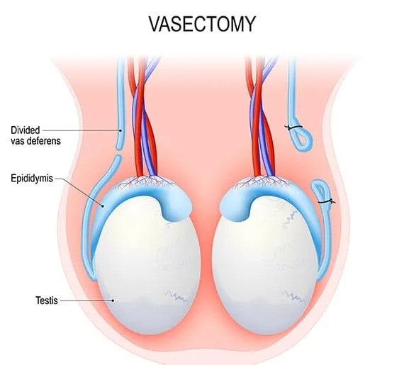 vasectomy sydney