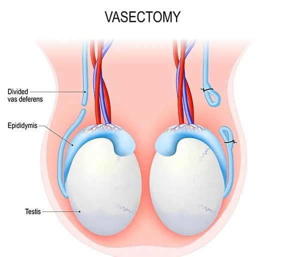 Vasectomy Sydney Conventional No Scalpel Technique