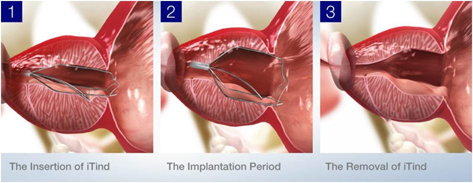 iTind procedure steps