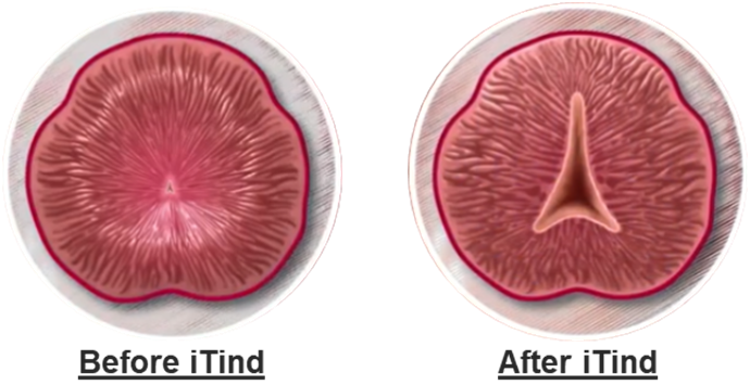 before and after iTind procedure